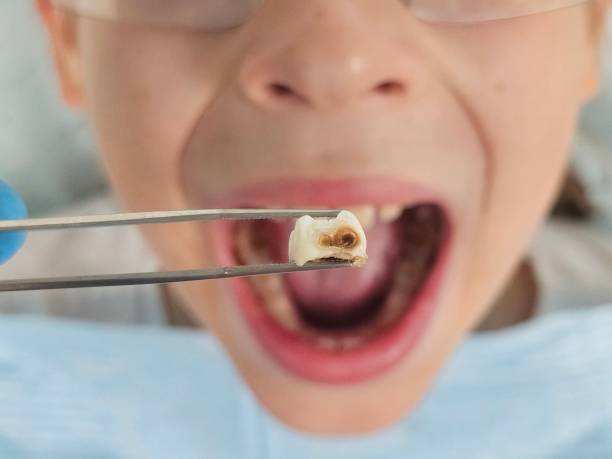 Best Knocked-Out Tooth (Avulsed Tooth) Treatment in Abingdon, MD